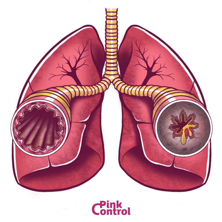 Bronchite Asmatica | Pink Control | Sito Di Informazioni